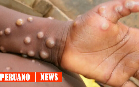 MINSA: Protégete de la Viruela del Mono